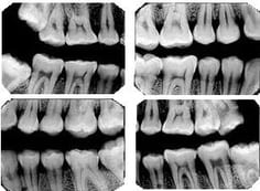 interproximal-exame-ddi-radiografia-odontologica